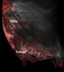 tibia bone cancer